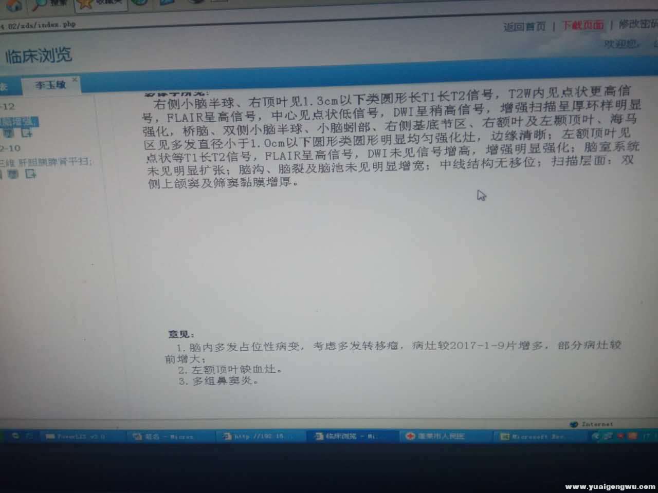 增强核磁结果