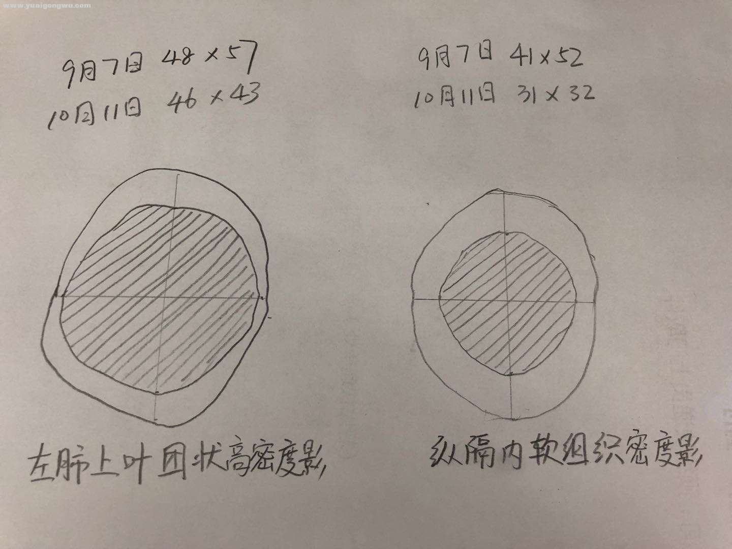 20210907~20211011肿瘤变化.jpg