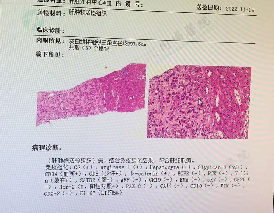 11月活检病理